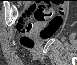 Sigmoid Colon Cancer - CTisus CT Scan