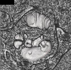 Sigmoid Colon Cancer - CTisus CT Scan