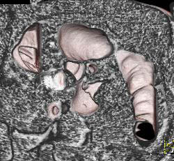 Sigmoid Colon Cancer - CTisus CT Scan