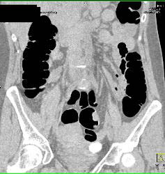 Sigmoid Colon Cancer - CTisus CT Scan