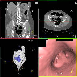 Rectal Tip and Polyps - CTisus CT Scan