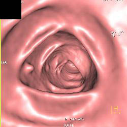 Rectal Tip and Polyps - CTisus CT Scan