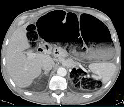 Obstructed Colon Due to Sigmoid Volvulus- See Sequence - CTisus CT Scan