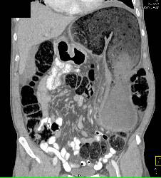 Obstructed Colon Due to Sigmoid Volvulus- See Sequence - CTisus CT Scan