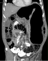 Obstructed Colon Due to Sigmoid Volvulus- See Sequence - CTisus CT Scan