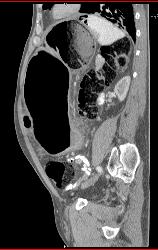 Obstructed Colon Due to Sigmoid Volvulus- See Sequence - CTisus CT Scan