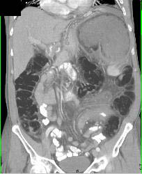 Obstructed Colon Due to Sigmoid Volvulus- See Sequence - CTisus CT Scan