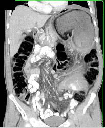 Obstructed Colon Due to Sigmoid Volvulus- See Sequence - CTisus CT Scan