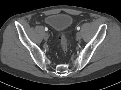 Colitis - CTisus CT Scan