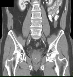 Colitis - CTisus CT Scan