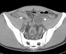 Crohn's Colitis - CTisus CT Scan