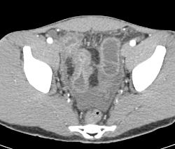 Crohn's Colitis - CTisus CT Scan