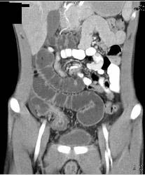 Crohn's Colitis - CTisus CT Scan