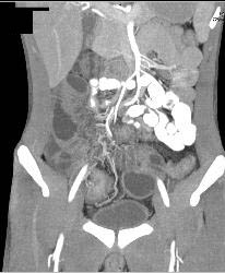 Crohn's Colitis - CTisus CT Scan