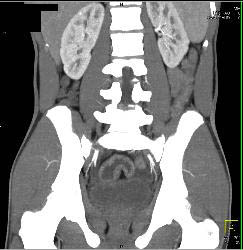 Crohn's Colitis - CTisus CT Scan