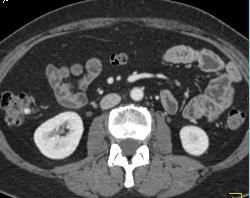 Pill in Right Colon Simulates A Bleed - CTisus CT Scan