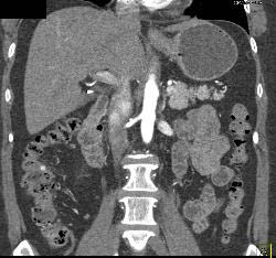 Pill in Right Colon Simulates A Bleed - CTisus CT Scan