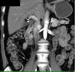 Pill in Right Colon Simulates A Bleed - CTisus CT Scan