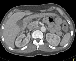 Infectious Colitis - CTisus CT Scan