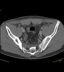 Infectious Colitis - CTisus CT Scan