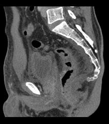 Colitis - CTisus CT Scan