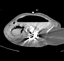 Ischemic Bowel With Pneumatosis - CTisus CT Scan