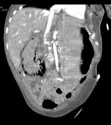 Ischemic Bowel With Pneumatosis - CTisus CT Scan