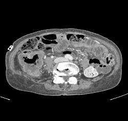 Cecal Cancer - CTisus CT Scan