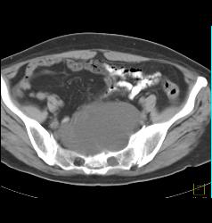 Dural Ectasia in Marfan Simulates A Pelvic Mass. Patient Eventually Developed A Fistulae Connecting the Meningocele With the Sigmoid Colon Due to Diverticulitis- See Full Sequence - CTisus CT Scan