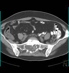 Dural Ectasia in Marfan Simulates A Pelvic Mass. Patient Eventually Developed A Fistulae Connecting the Meningocele With the Sigmoid Colon Due to Diverticulitis- See Full Sequence - CTisus CT Scan