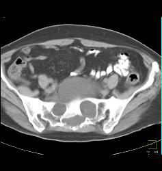 Dural Ectasia in Marfan Simulates A Pelvic Mass. Patient Eventually Developed A Fistulae Connecting the Meningocele With the Sigmoid Colon Due to Diverticulitis- See Full Sequence - CTisus CT Scan