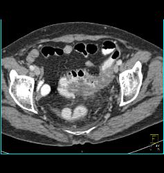 Dural Ectasia in Marfan Simulates A Pelvic Mass. Patient Eventually Developed A Fistulae Connecting the Meningocele With the Sigmoid Colon Due to Diverticulitis- See Full Sequence - CTisus CT Scan