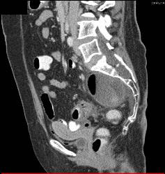 Dural Ectasia in Marfan Simulates A Pelvic Mass. Patient Eventually Developed A Fistulae Connecting the Meningocele With the Sigmoid Colon Due to Diverticulitis- See Full Sequence - CTisus CT Scan