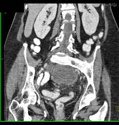 Dural Ectasia in Marfan Simulates A Pelvic Mass. Patient Eventually Developed A Fistulae Connecting the Meningocele With the Sigmoid Colon Due to Diverticulitis- See Full Sequence - CTisus CT Scan