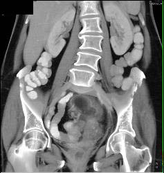 Dural Ectasia in Marfan Simulates A Pelvic Mass. Patient Eventually Developed A Fistulae Connecting the Meningocele With the Sigmoid Colon Due to Diverticulitis- See Full Sequence - CTisus CT Scan