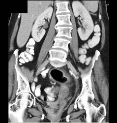 Dural Ectasia in Marfan Simulates A Pelvic Mass. Patient Eventually Developed A Fistulae Connecting the Meningocele With the Sigmoid Colon Due to Diverticulitis- See Full Sequence - CTisus CT Scan