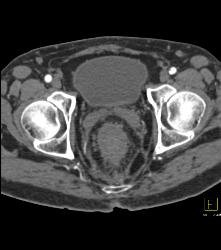 Colitis of Rectum and Sigmoid- See Sequence - CTisus CT Scan