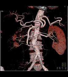 Colitis of Rectum and Sigmoid- See Sequence - CTisus CT Scan