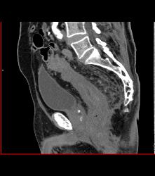 Colitis of Rectum and Sigmoid- See Sequence - CTisus CT Scan