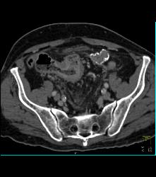 Colitis of Rectum and Sigmoid- See Sequence - CTisus CT Scan