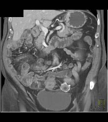 Colitis of Rectum and Sigmoid- See Sequence - CTisus CT Scan