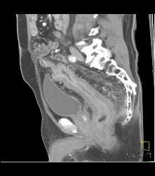 Colitis of Rectum and Sigmoid- See Sequence - CTisus CT Scan