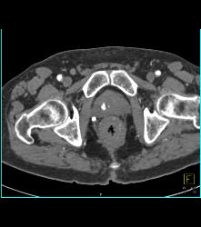 Colitis of Rectum and Sigmoid- See Sequence - CTisus CT Scan