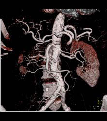 Colitis of Rectum and Sigmoid- See Sequence - CTisus CT Scan