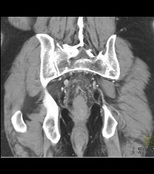 Colitis of Rectum and Sigmoid- See Sequence - CTisus CT Scan