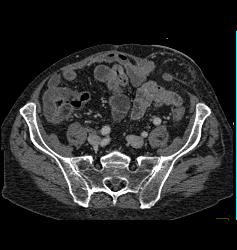 Infectious Colitis of the Colon - CTisus CT Scan