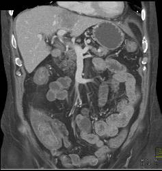 Infectious Colitis of the Colon - CTisus CT Scan