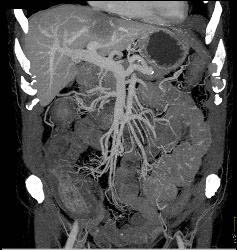 Infectious Colitis of the Colon - CTisus CT Scan