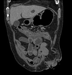 Infectious Colitis of the Colon - CTisus CT Scan