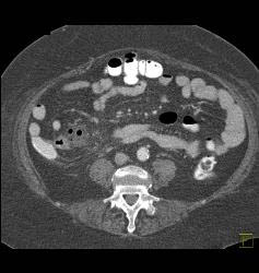 Perforated Appendix With Appendicitis - CTisus CT Scan